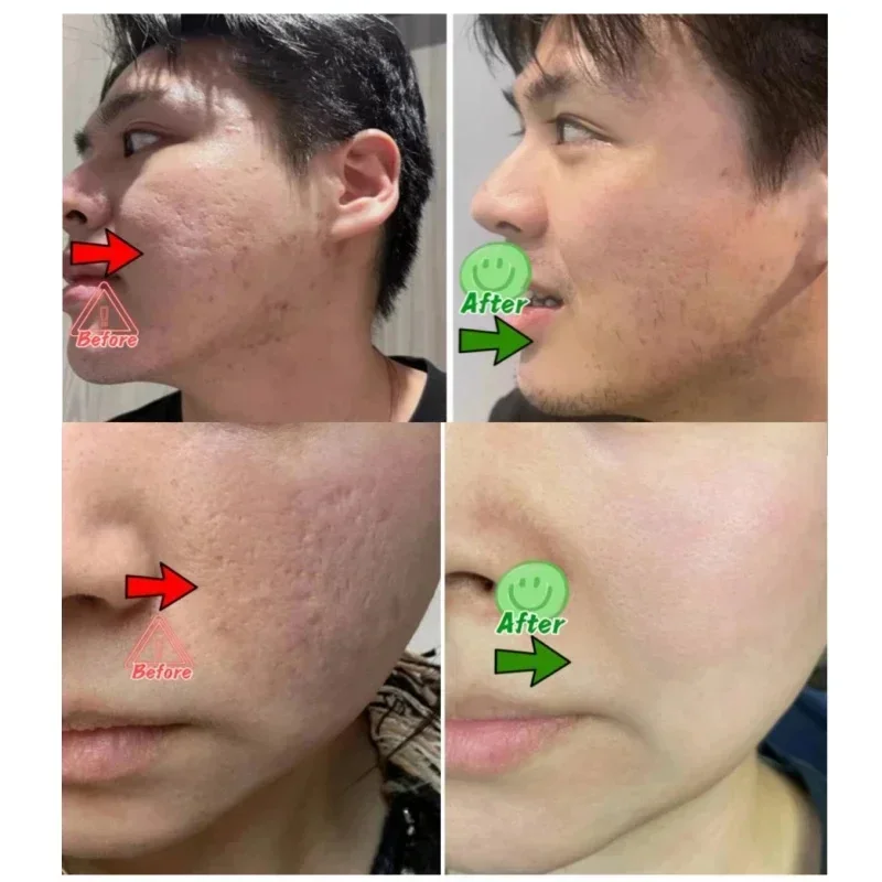 Crème de nettoyage des pores à - Azelaic Acid Cream avis et prix